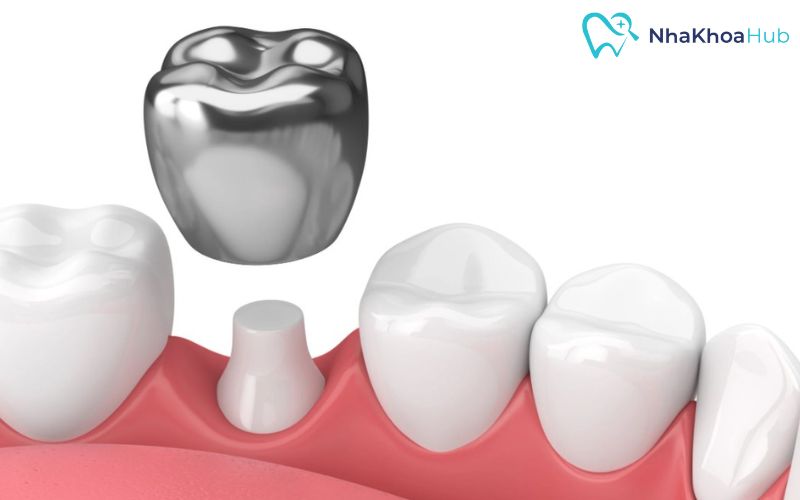 Chỉ cần mài chỉnh nhẹ răng là có thể lắp vừa vặn cho trẻ