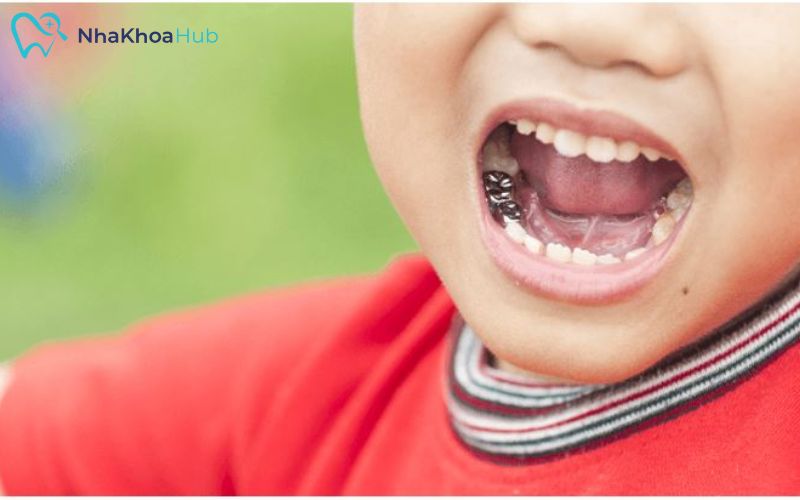 Phương pháp đeo mão răng đặc biệt phù hợp với trẻ dưới 4 tuổi