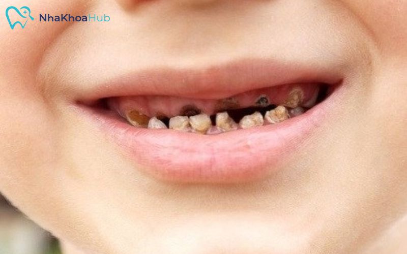 Trẻ có răng bị bất thường do di truyền, khiến men răng mềm và nhanh chóng tự mủn cần sử dụng bọc thép để tái tạo răng