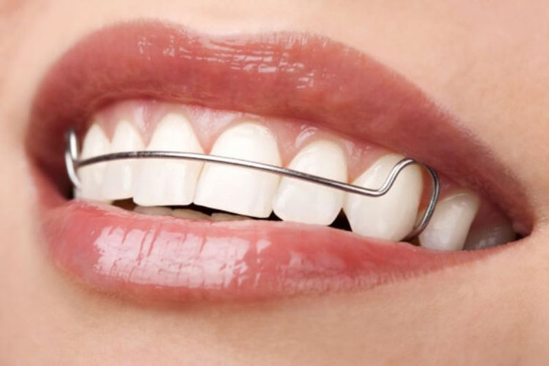 Nhiều người thắc mắc hàm duy trì có cần đeo vĩnh viễn sau khi niềng không