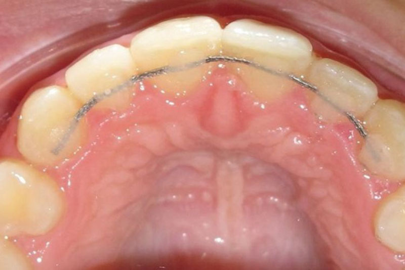 Khí cụ gắn vào mặt trong của răng, có tính thẩm mỹ cao