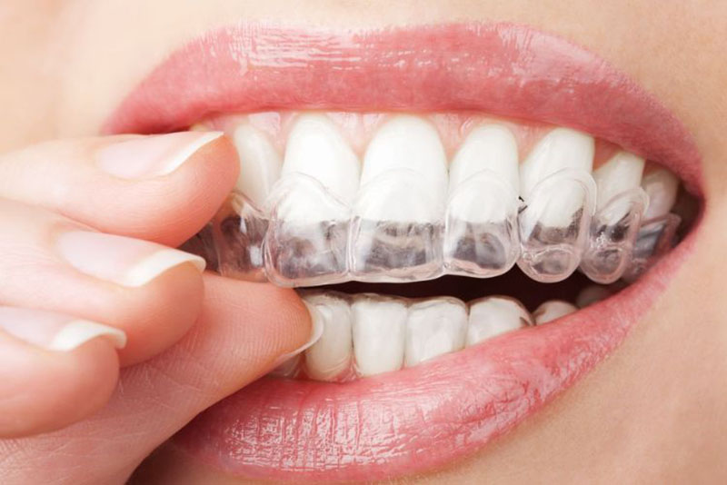 Khí cụ khay trong suốt thiết kế riêng cho từng người