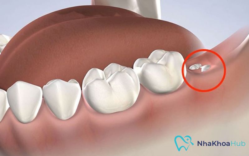 Nhổ răng còn sót chân gây khó chịu và tiềm ẩn nguy cơ ảnh hưởng đến sức khỏe răng miệng