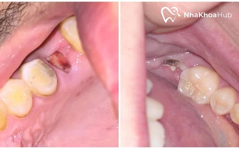 Chân răng còn sót lại khiến cơ thể bị sốt và dễ nhiễm khuẩn