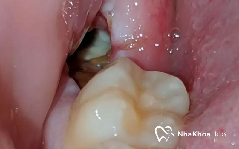 Vùng nướu vừa mất răng bị sưng tấy, xuất hiện mủ 