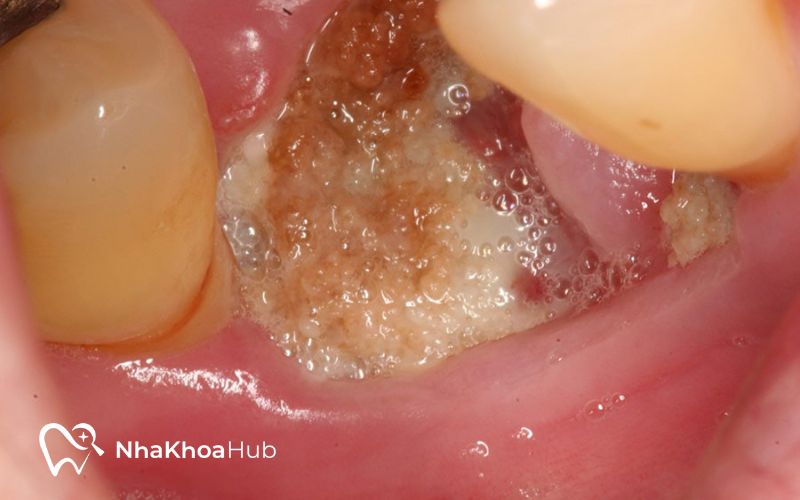 Nhận biết sớm biểu hiện nhiễm trùng sau khi nhổ bỏ răng để điều trị kịp thời