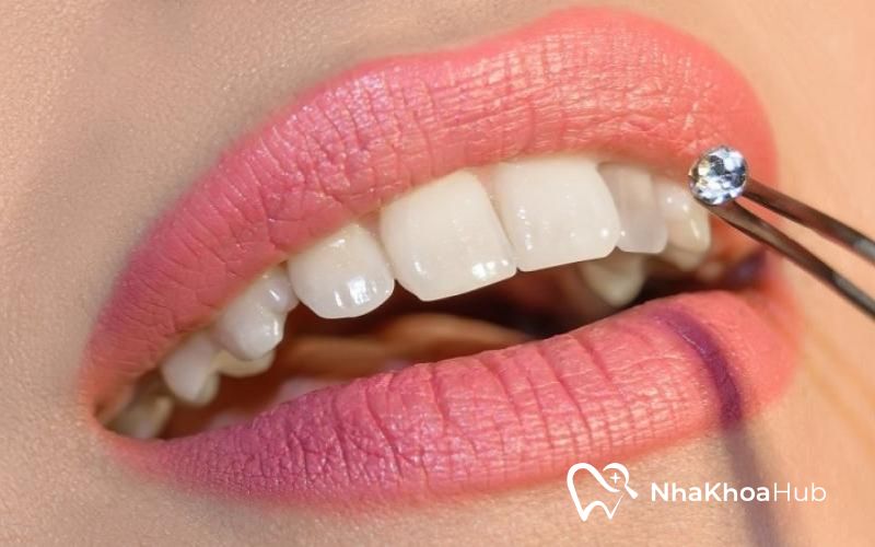 Tư vấn: Nên đính đá răng ở đâu đảm bảo độ bền và uy tín? Đá được đính vào răng chắc chắn, đảm bảo độ bền cao