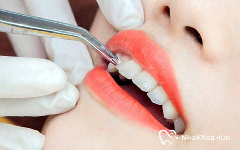 Tư vấn: Nên đính đá răng ở đâu đảm bảo độ bền và uy tín? Gắn đá không xâm lấn, hạn chế tổn hại đến men răng