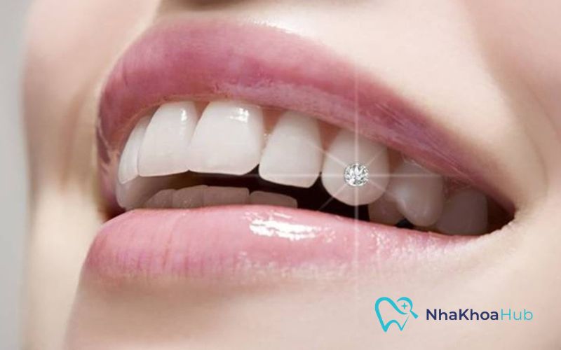 Tư vấn: Nên đính đá răng ở đâu đảm bảo độ bền và uy tín? Lựa chọn địa điểm gắn đá uy tín mang lại hiệu quả thẩm mỹ cao