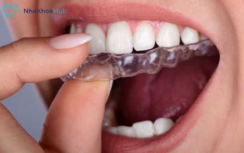 Máng bảo vệ răng giúp hàm tránh khỏi các chấn thương không mong muốn