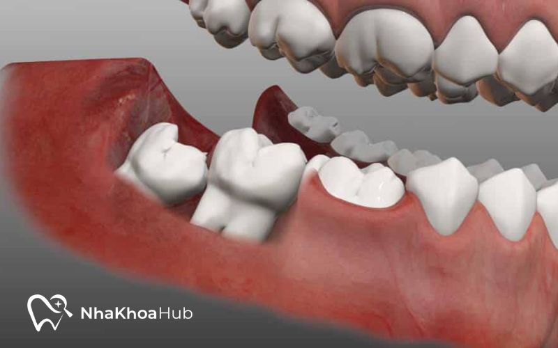 Răng khôn mọc lệch cần nhổ để không ảnh hưởng đến sức khỏe