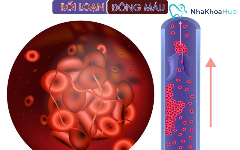 Hội chứng rối loạn đông máu khiến cục máu đông khó hình thành