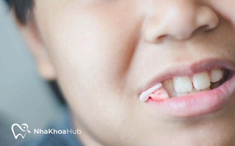 Cầm máu đúng cách sau nhổ răng giúp ngăn ngừa nhiễm trùng