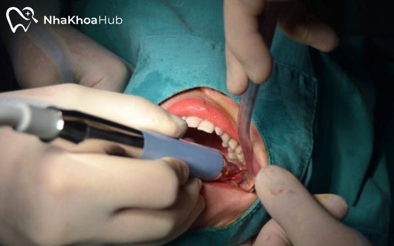 Công nghệ siêu âm giúp nhổ răng nhanh chóng, giảm tổn thương mô mềm