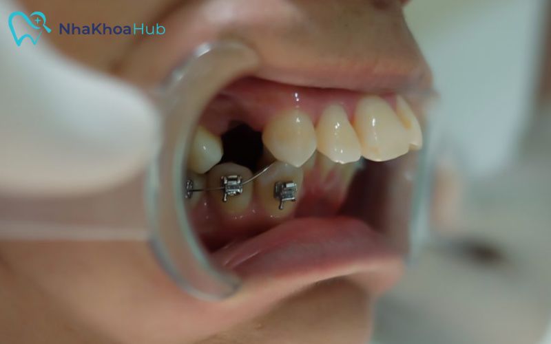 Nhổ răng tạo khoảng trống hoặc hỗ trợ niềng răng an toàn, tránh rủi ro