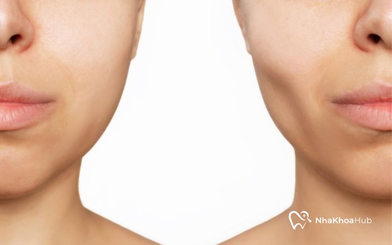 Tình trạng bị hóp má sau khi nhổ răng gây mất thẩm mỹ cho nhiều người 