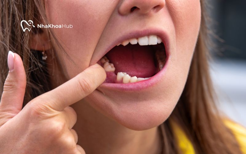 Nguyên nhân gây hóp má sau khi nhổ răng là sự thay đổi trong cấu trúc xương và mô mềm