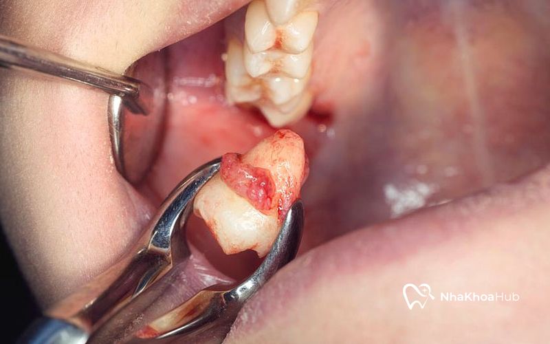 Nhổ răng 7 dẫn đến tình trạng hóp má nếu không có sự chăm sóc hợp lý