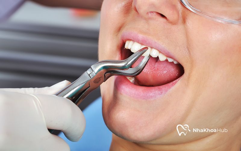 Nhổ răng hàm trên có thể dẫn đến hiện tượng hóp má