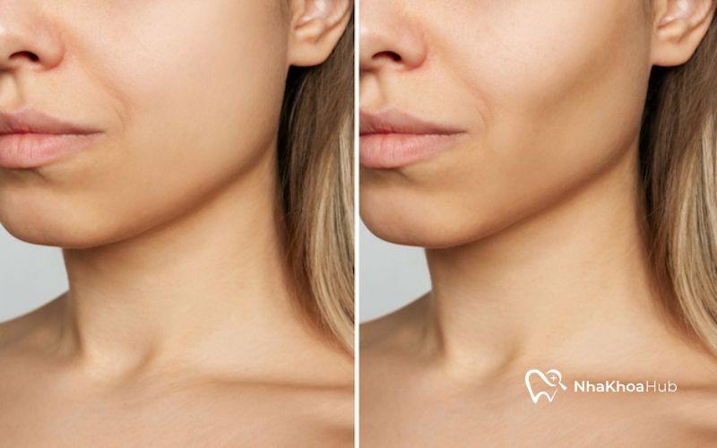 Hóp má sau khi nhổ răng ảnh hưởng đến việc ăn uống và phát âm