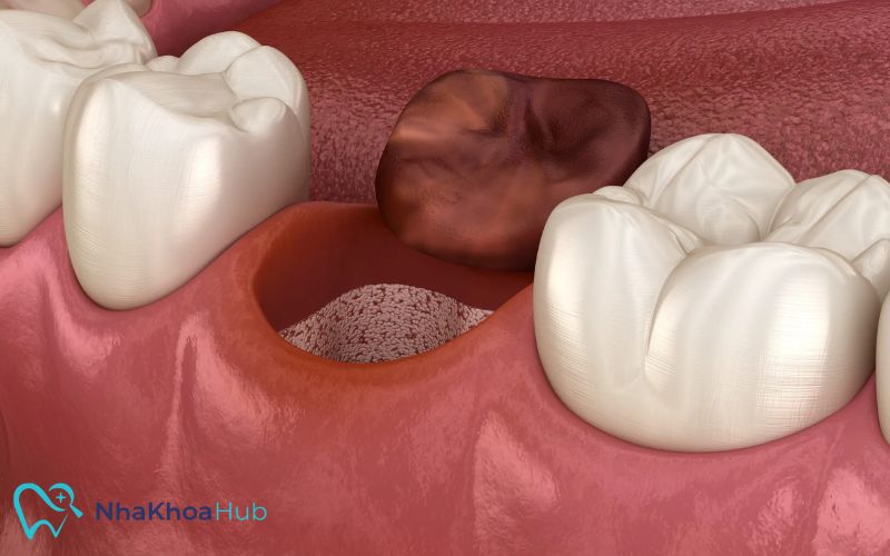 Giải đáp chi tiết: Nhổ răng có nên súc miệng nước muối không? Súc lại miệng bằng nước sạch vài lần để loại bỏ lượng muối còn sót lại, tránh tình trạng khô miệng