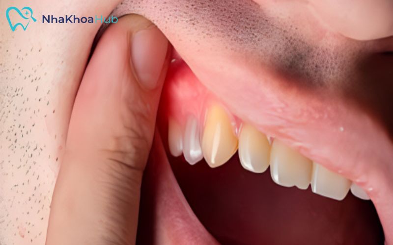 Giải đáp chi tiết: Nhổ răng có nên súc miệng nước muối không? Tránh sử dụng ống hút ít nhất 48 giờ sau khi nhổ răng để bảo vệ nướu