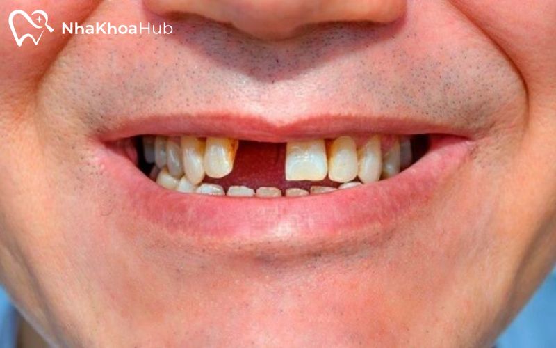 Chăm sóc đúng cách sau nhổ phần răng cửa để đảm bảo quá trình hồi phục an toàn