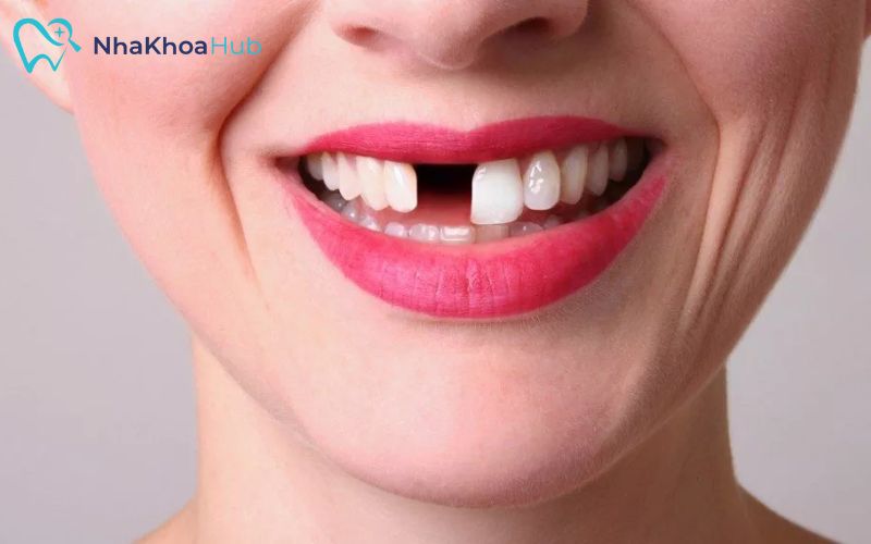 Mất răng khiến nhiều người cảm thấy tự ti, ngại giao tiếp, khi nói chuyện hoặc cười