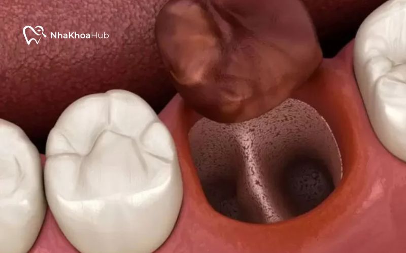 Khi nào cần nhổ răng để niềng? Trường hợp không được nhổ Sau khi nhổ răng sẽ có lỗ hổng tạm thời tại vị trí răng được nhổ