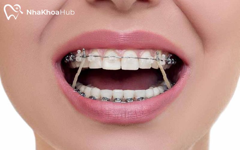 Lấy đi răng cối để chỉnh nha, tạo khoảng trống cho răng di chuyển