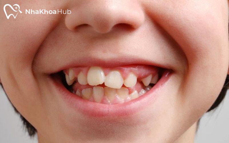 Ảnh hưởng của nhổ răng lồi xỉ và phương pháp xử lý an toàn Lựa chọn đúng phương pháp điều trị răng lồi xỉ để đảm bảo an toàn và đạt hiệu quả