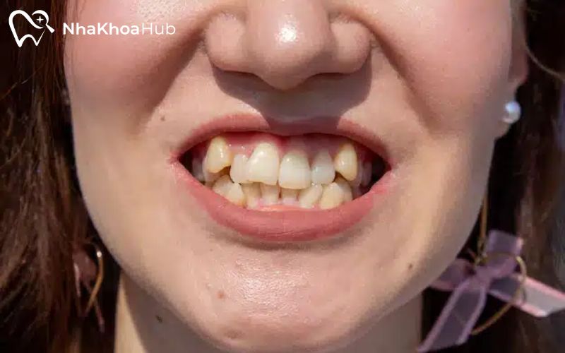 Ảnh hưởng của nhổ răng lồi xỉ và phương pháp xử lý an toàn Răng mọc lệch lạc có thể gây sai lệch khớp cắn, ảnh hưởng đến cấu trúc khuôn mặt