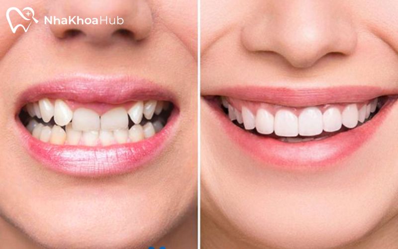 Ảnh hưởng của nhổ răng lồi xỉ và phương pháp xử lý an toàn Răng sứ có kiểu dáng và màu sắc tương tự răng thật, thẩm mỹ cao và giúp răng đều hơn