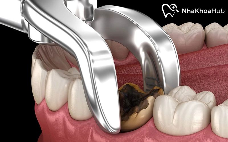 Nhổ răng số 6: Khi nào nên nhổ và cách chăm sóc hậu phẫu Nắm rõ các trường hợp cần nhổ răng vị trí số 6 và những lưu ý trong quá trình thực hiện để đảm bảo sức khỏe răng miệng