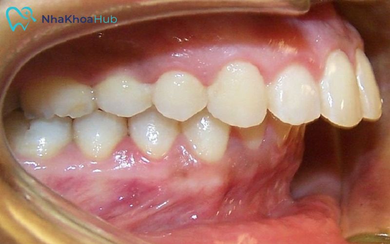 Nhổ răng số 6: Khi nào nên nhổ và cách chăm sóc hậu phẫu Nếu răng số 6 gây viêm nhiễm lan sang, việc nhổ bỏ răng là cần thiết để ngăn ngừa biến chứng nguy hiểm