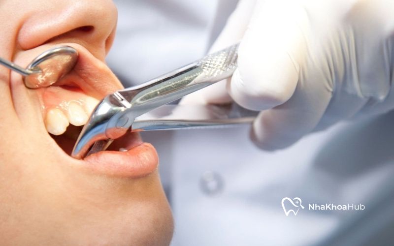 Nhổ răng số 7 có thể gây ra những vấn đề nghiêm trọng nếu không được chăm sóc đúng cách