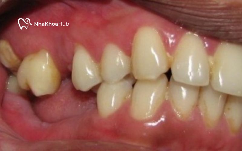 Nhổ răng hàm số 7 gây mất cân bằng trong hàm và làm thay đổi khớp cắn