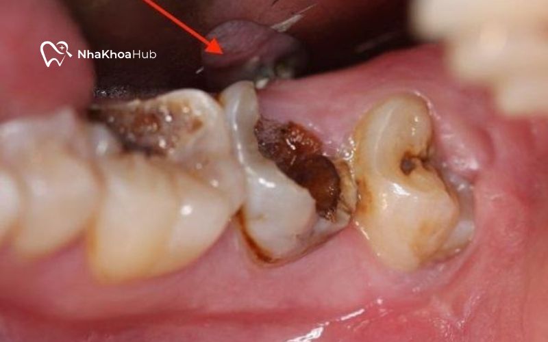 Sâu răng nặng bắt buộc phải loại bỏ răng số 7