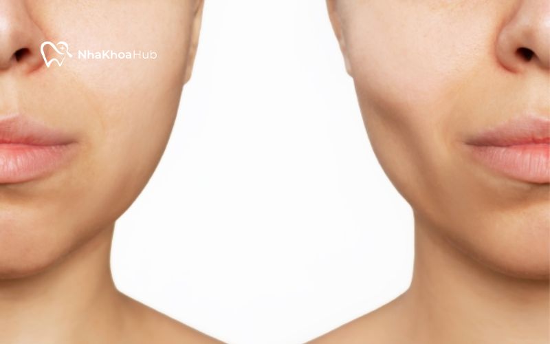 Bị hóp má sau khi nhổ răng khi bị mất cấu trúc xương quanh răng