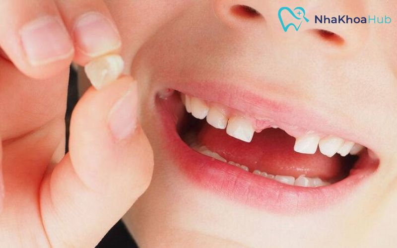 Các tế bào huỷ xương sẽ làm tiêu biến phần chân của răng
