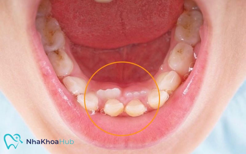 Răng vĩnh viễn đã bắt đầu mọc lên nhưng răng sữa vẫn còn chắc