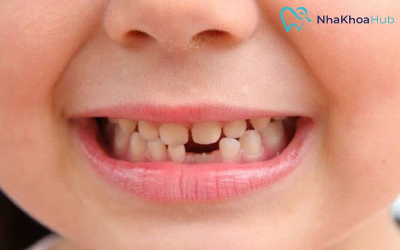 Các bé gái thường có xu hướng mọc răng nhanh hơn các bé trai