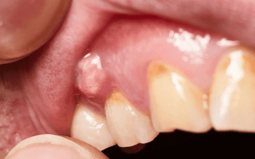 U nang nếu bị nhiễm trùng sẽ gây đau nhức và sưng đỏ