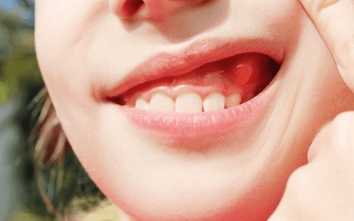 Nướu răng mọc thịt không xử lý đúng cách có thể gây viêm loét, chảy máu,...