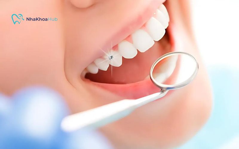 Răng đính đá bao nhiêu tiền? Bảng giá chi tiết mới nhất Đính đá răng là xu hướng làm đẹp của nhiều người hiện nay