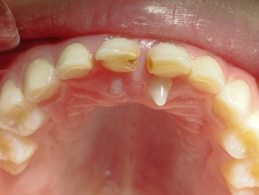 Những người bị thừa răng, u răng, thiếu khoảng, bệnh quanh thân răng,... đều có khả năng dễ xuất hiện răng ngầm 