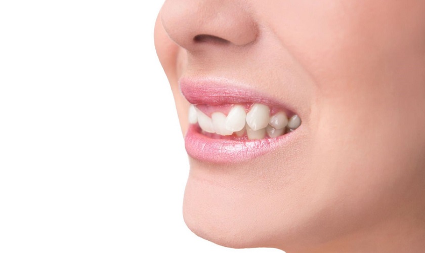 Tại sao răng mọc thừa? Cách xử lý răng thừa an toàn Mọc thừa răng làm cung răng mất cân đối, răng mọc lộn xộn không đúng vị trí khiến nụ cười kém thẩm mỹ