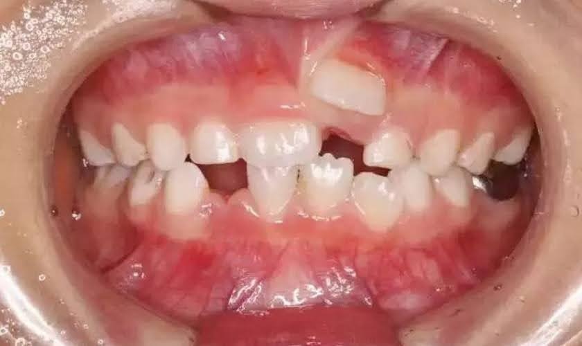 Răng mọc trên lợi: Nguyên nhân, dấu hiệu và cách xử lý hiệu quả Nguyên nhân phổ biến gây mọc ngược răng trên lợi gồm: khuôn hàm hẹp, bẩm sinh, mất mầm răng vĩnh viễn,...