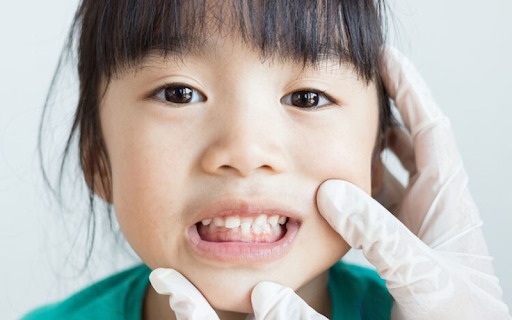 Răng mọc lệch trong vòm miệng có thể làm khuôn mặt mất cân đối