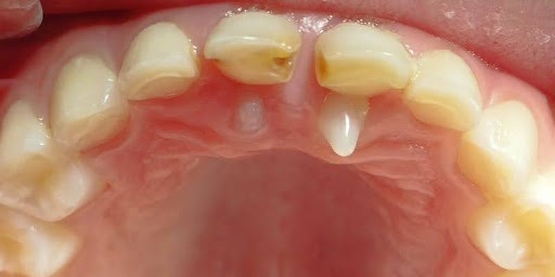 Hiện tượng này gây ra cảm giác khó chịu khi nhai thức ăn hoặc nói chuyện vì một chiếc răng dường như "ẩn mình" trong khoang lợi 